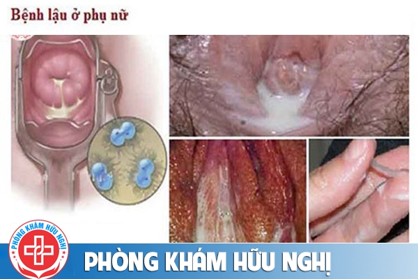 Âm đạo chảy mủ do lậu